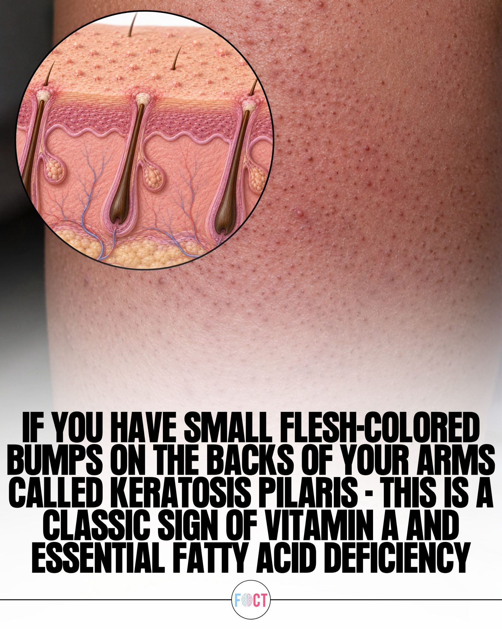 Keratosis Pilaris: Vitamin Deficiency Signs on Arms