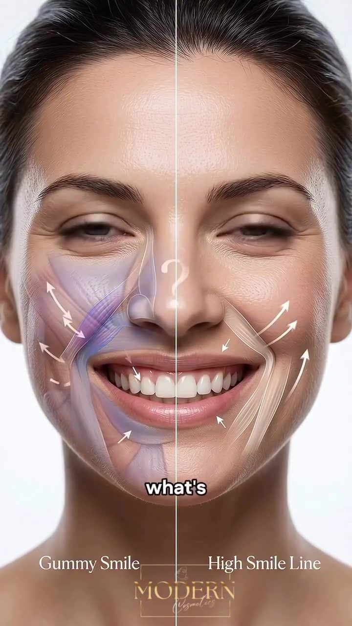 Gummy vs High Smile Line: What's the Difference?