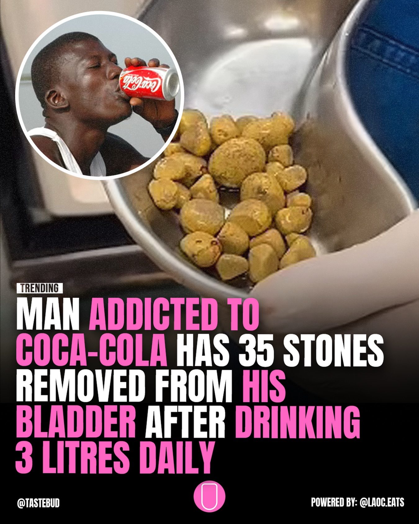 Man's 3-Liter Daily Coke Habit Leads to 35 Bladder Stones