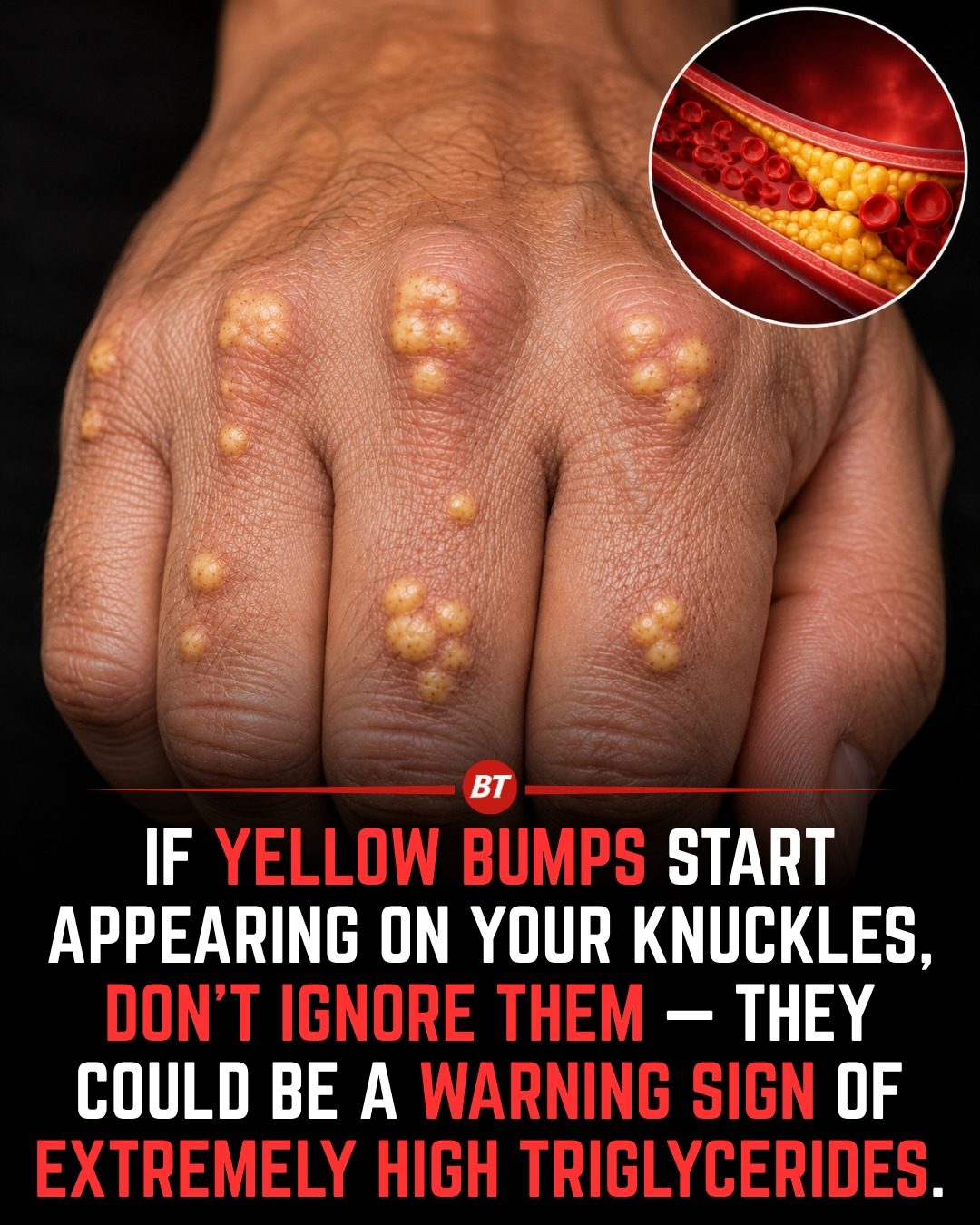 When Knuckle Bumps Signal High Triglycerides