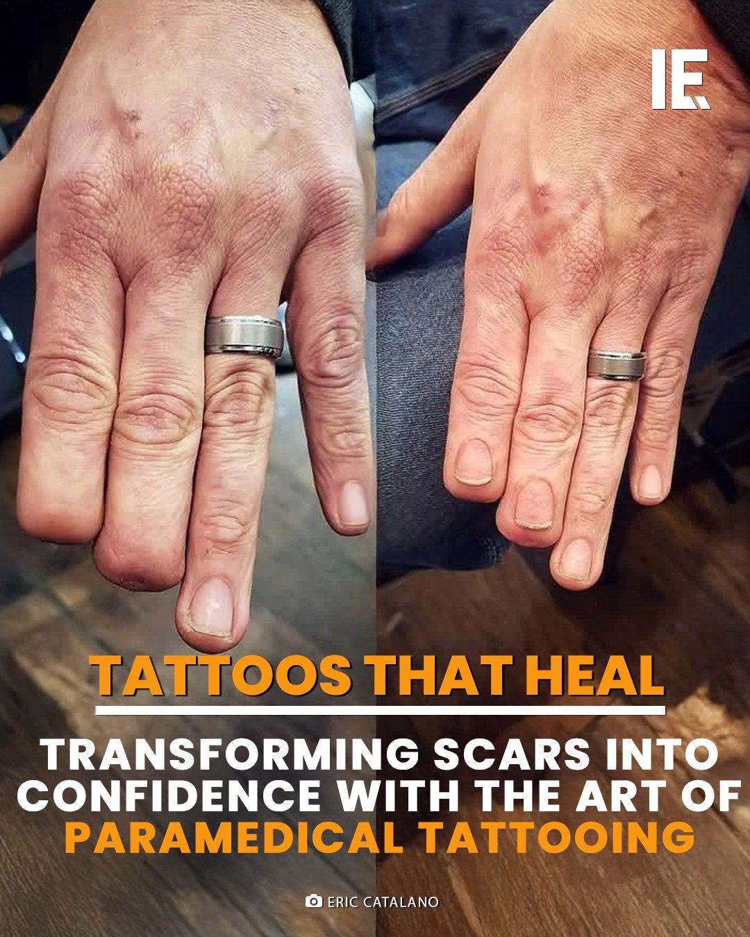 Transform Scars into Confidence with Paramedical Tattooing