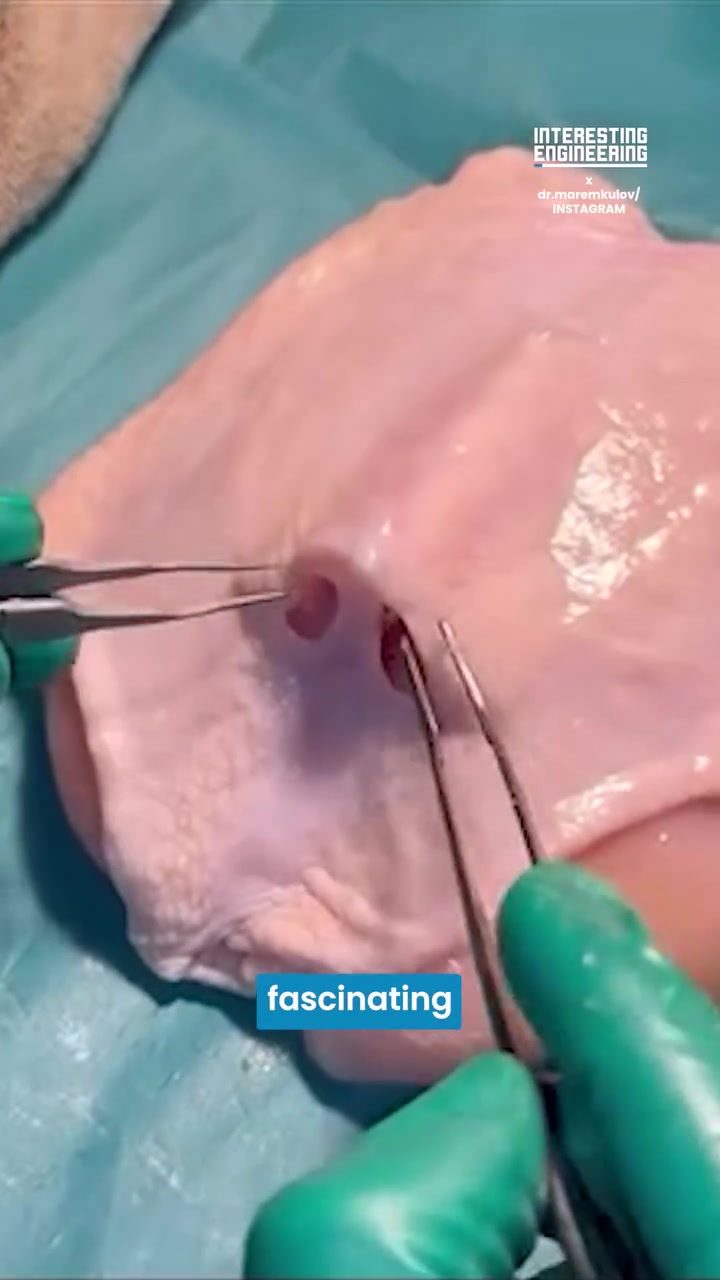 Dr. Maremkulov Demonstrates Chicken Rhinoplasty for Nasal Reconstruction
