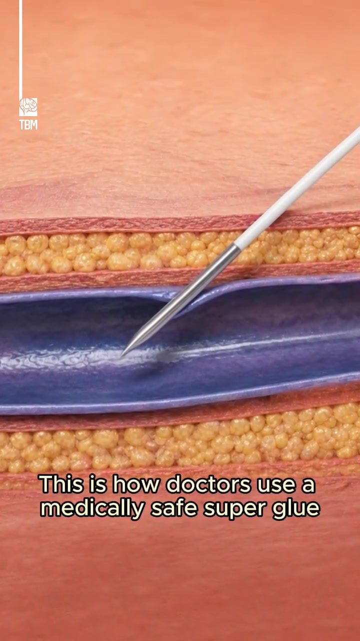 Minimally Invasive Varicose Vein Treatment using Medical Glue