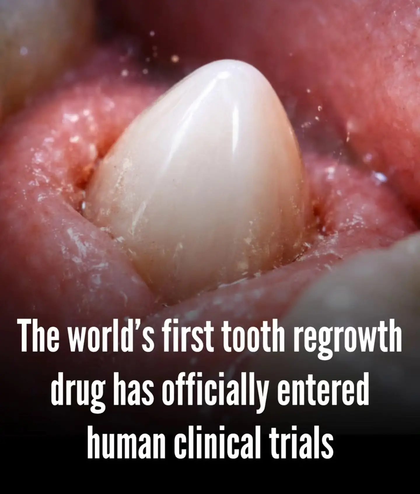 First Human Trials for Tooth Regrowth Drug