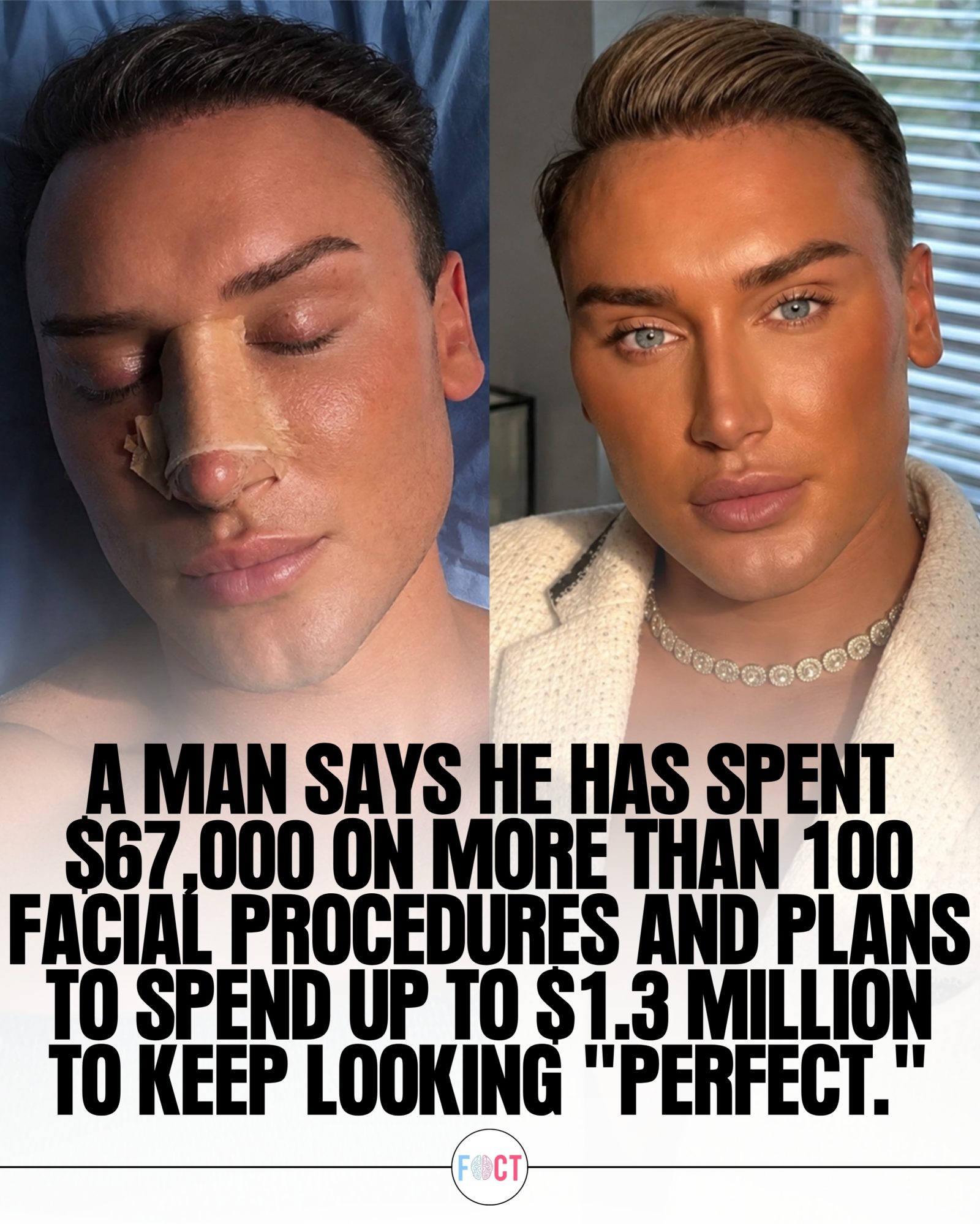 Man Spends $67,000 on 100+ Facial Procedures, Plans to Spend More
