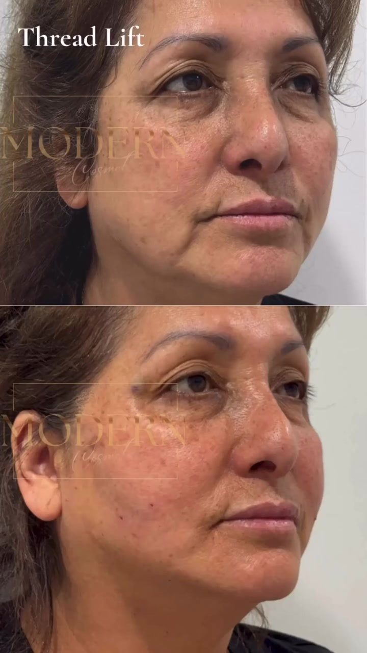 Thread Lifts: Non Surgical Facial Rejuvenation
