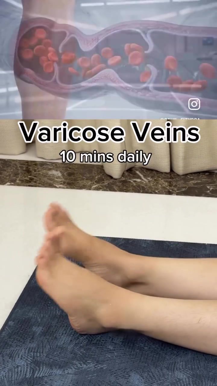 Easing Varicose Veins: A 10-Minute Daily Exercise Routine