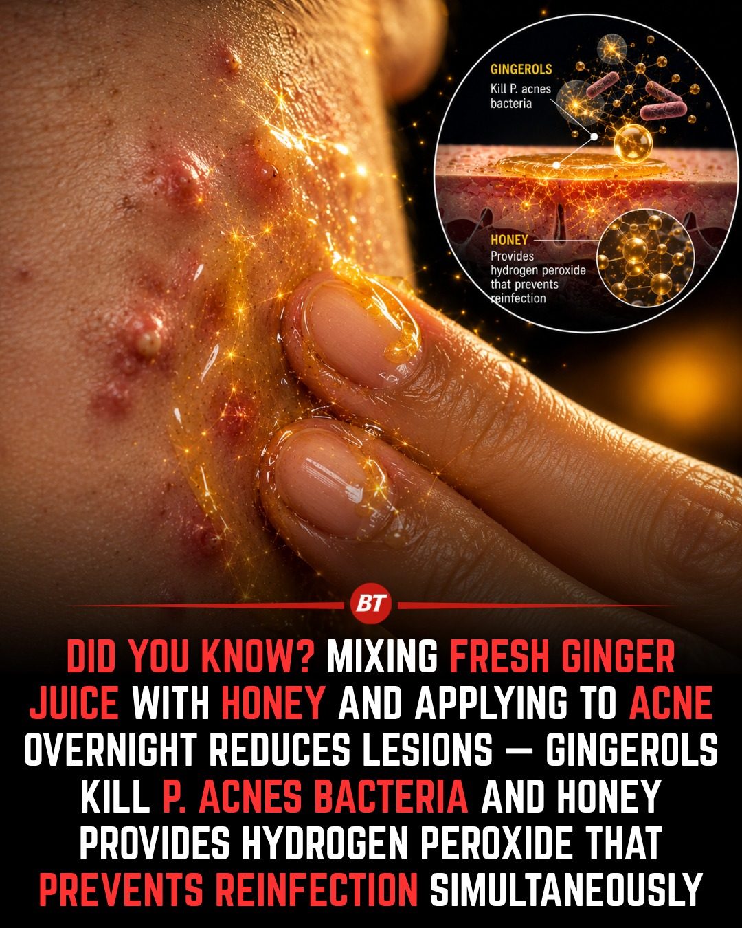 Ginger & Honey: A Natural Acne Treatment You Should Try
