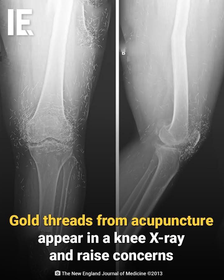 Unexpected Gold Threads Found in Knee X-Ray