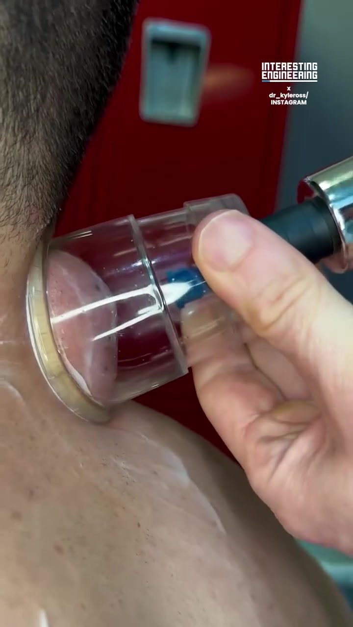 Educational Fluid Dynamics Demonstration with Cupping Therapy