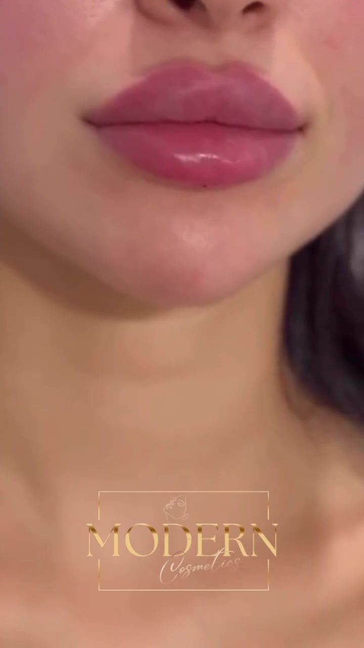 Modern Cosmetics' Subtle Lip Filler Transformations