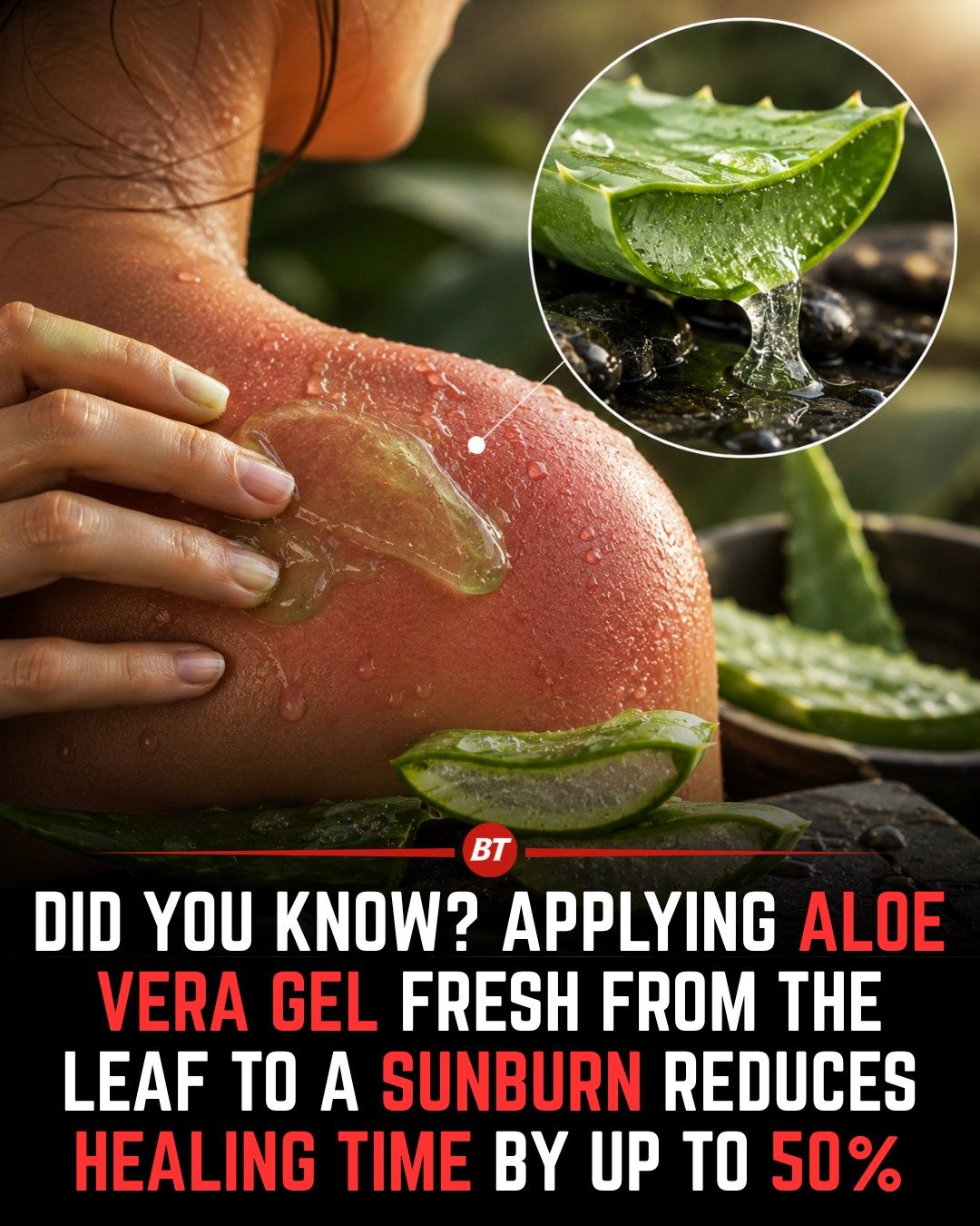 Aloe Vera Gel: Reduce Sunburn Healing Time by 50%