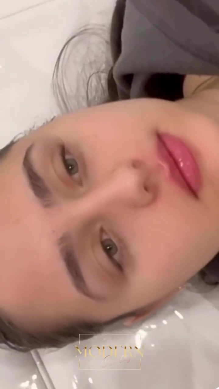 Modern Cosmetics: Precision in Lip Filler Enhancements