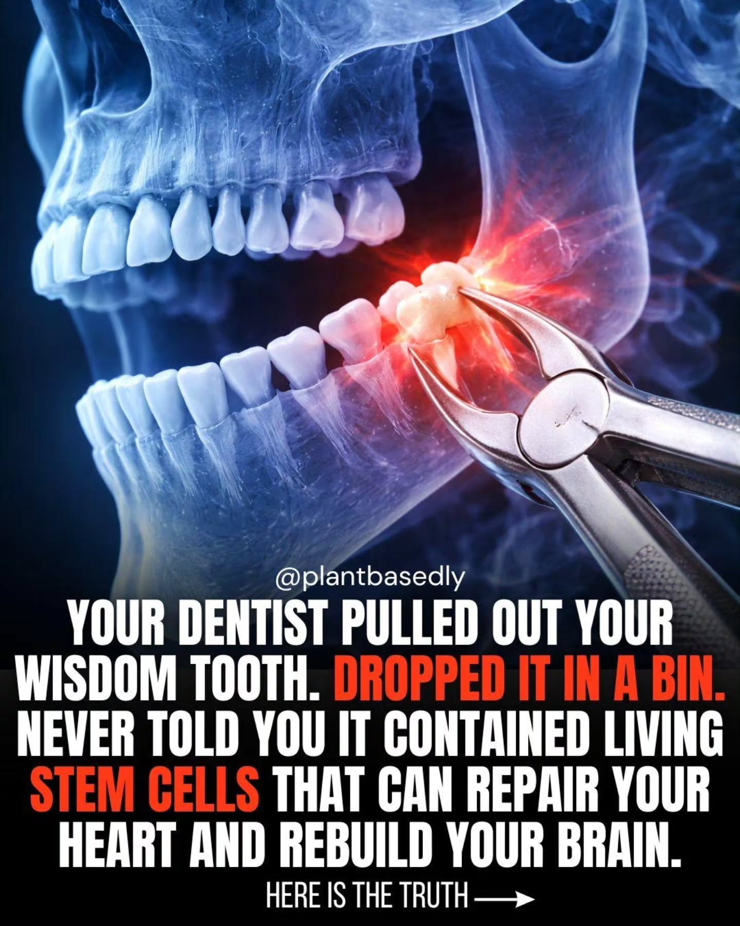 Dental Pulp Stem Cells in Wisdom Teeth: Uses and Potential