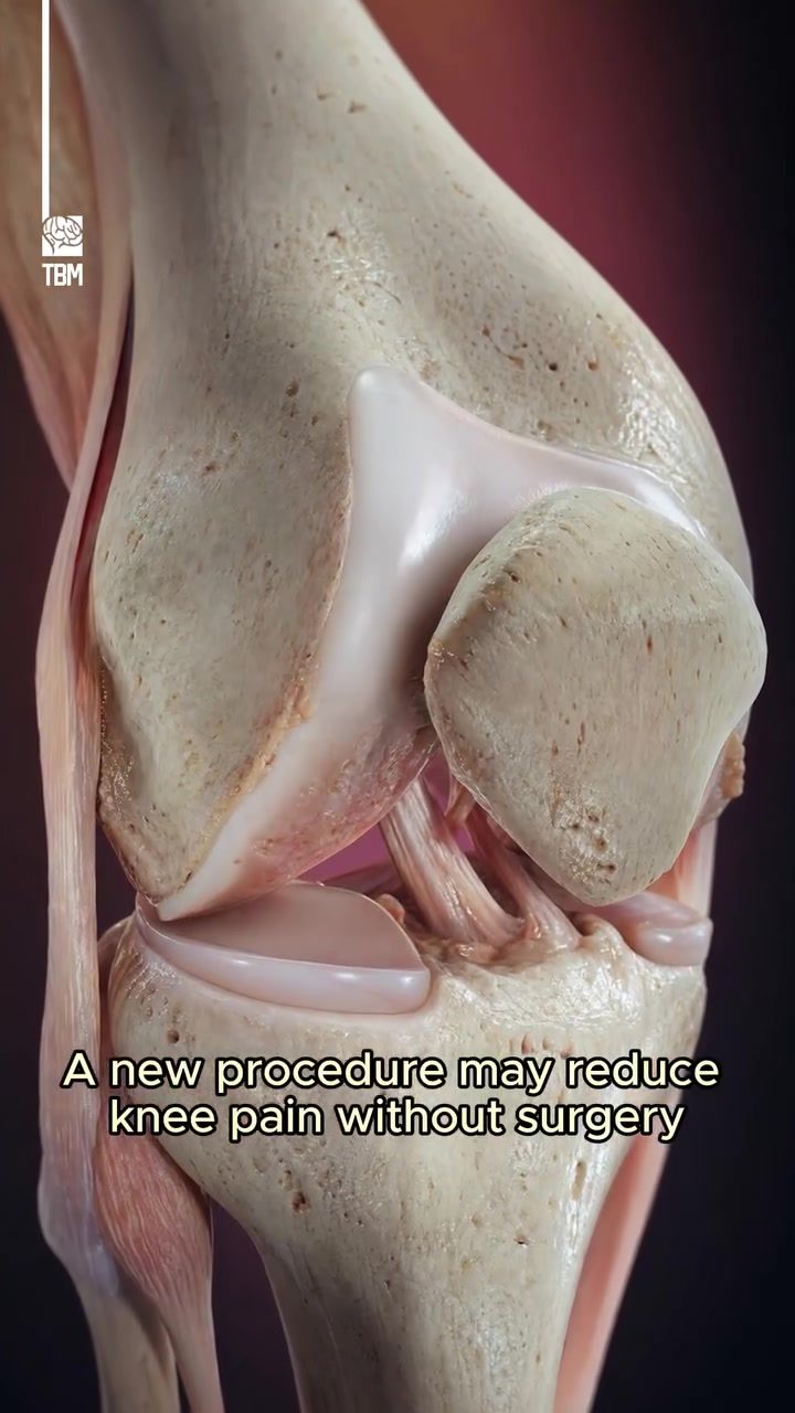 Minimally Invasive Genicular Embolization for Knee Pain