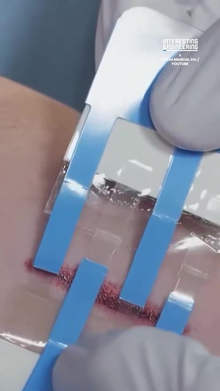 Clozex Medical Device: A Non-Invasive Wound Closure Solution