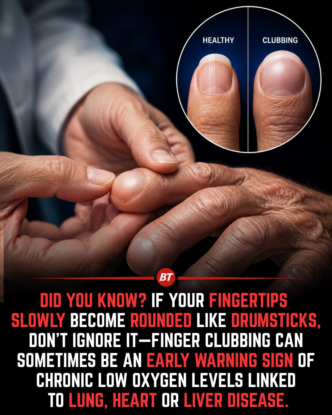 Understanding Finger Clubbing: Early Sign of Health Issues