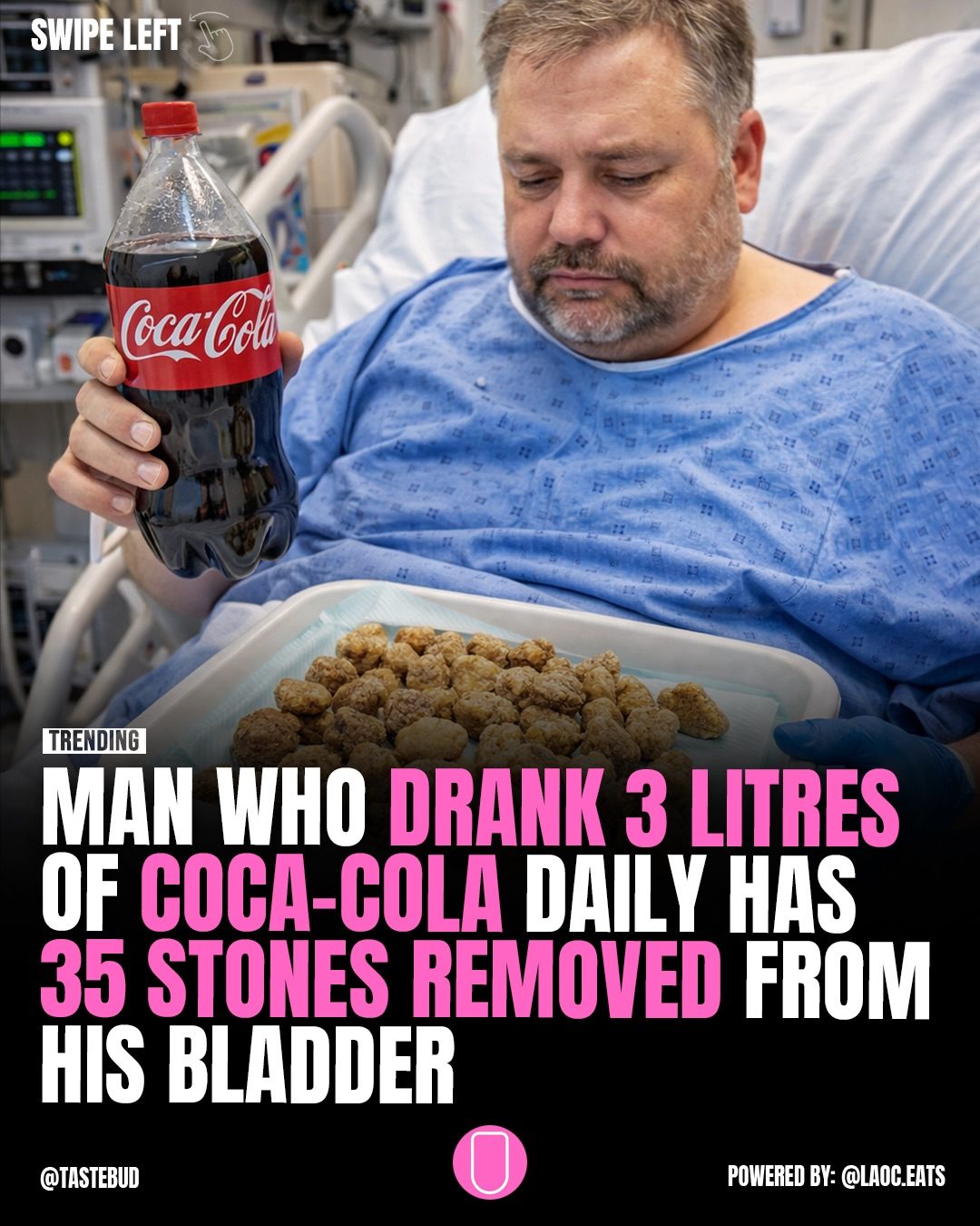Bladder Stones: The Shocking Impact of Daily Soft Drinks