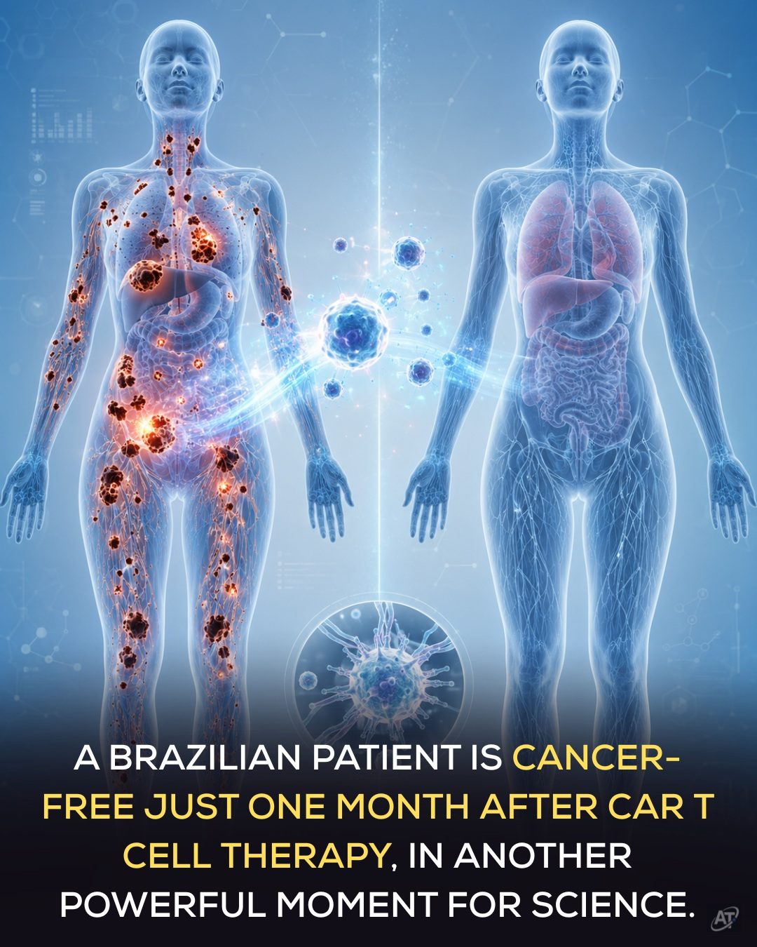 Cancer-Free in 30 Days: Brazilian Patient's CAR T-Cell Success