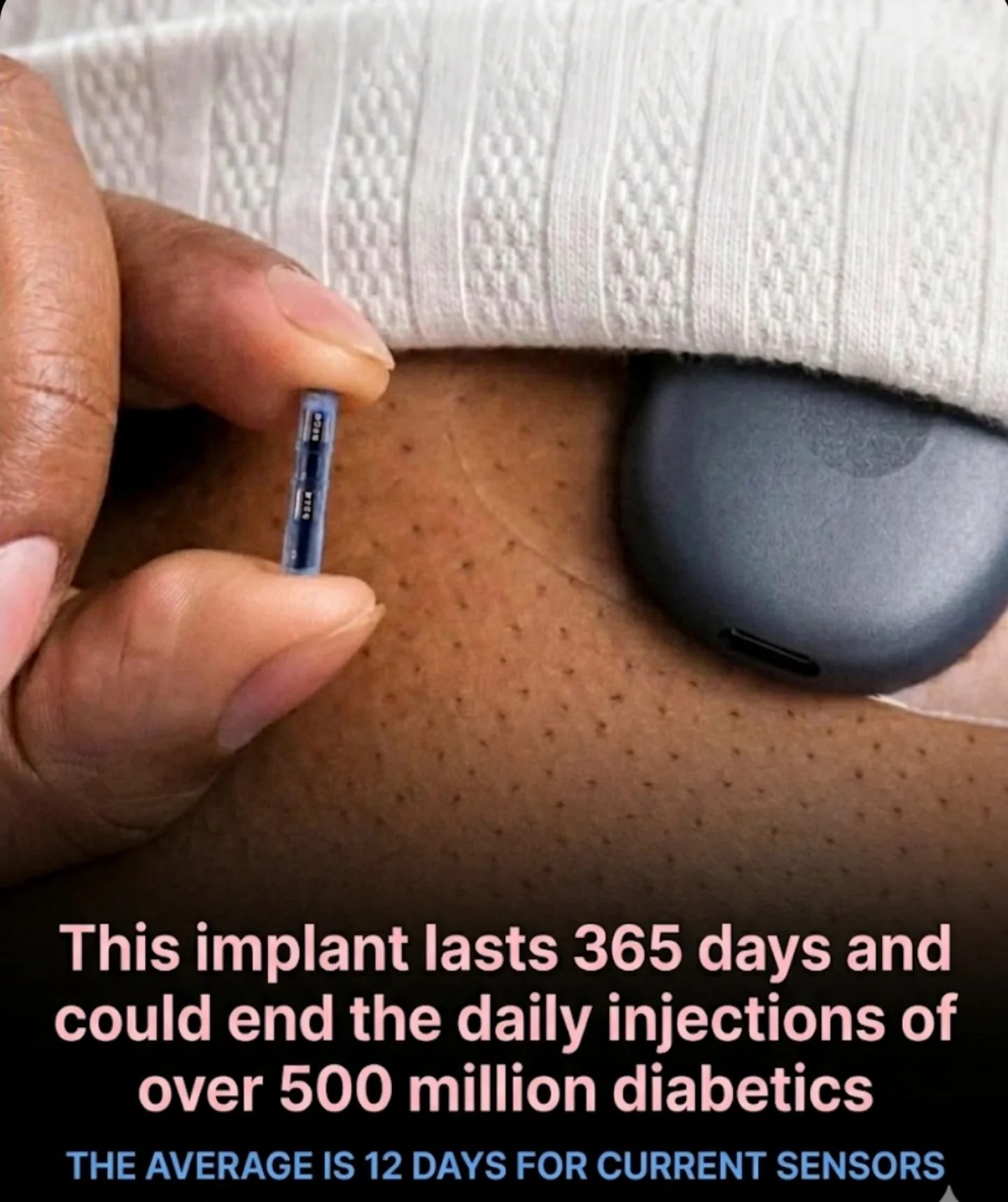The Eversense 365: Transforming Diabetes Care with 365-Day Monitoring