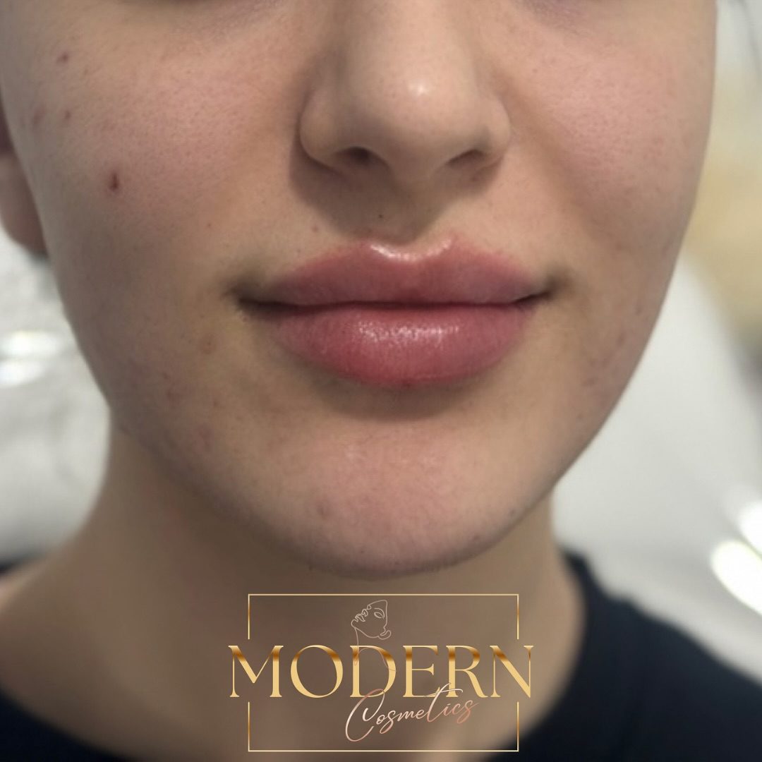 Explore Lip Filler Transformations with Modern Cosmetics