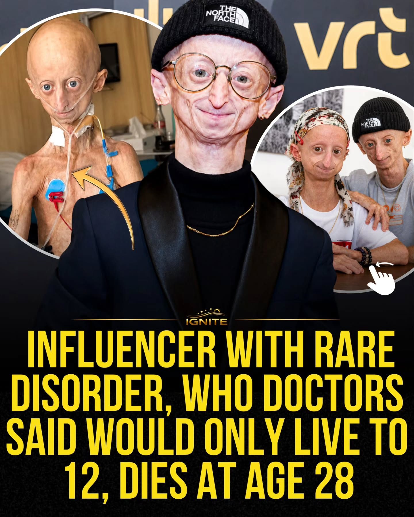 Michiel Vandeweert: How an Influencer Defied Progeria Predictions