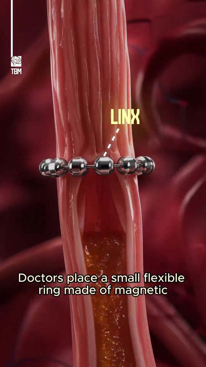 LINX Device: Magnet Bead Ring for Acid Reflux