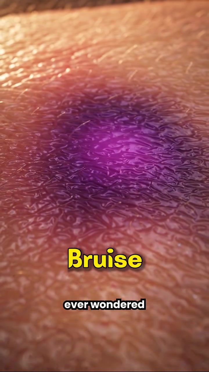 Why Do Bruises Change Color?
