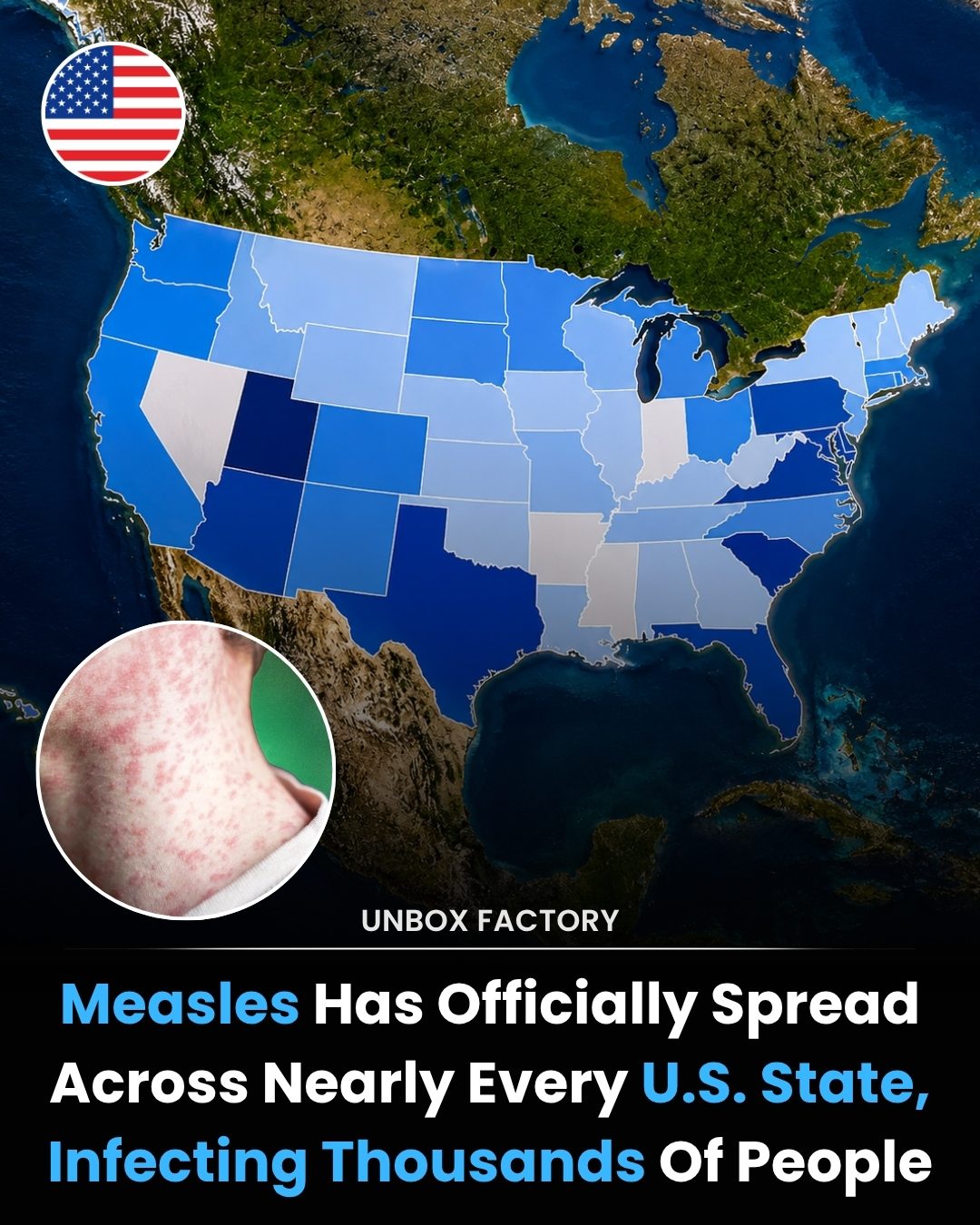 The Measles Outbreak: How It's Spreading and Why Vaccination Matters