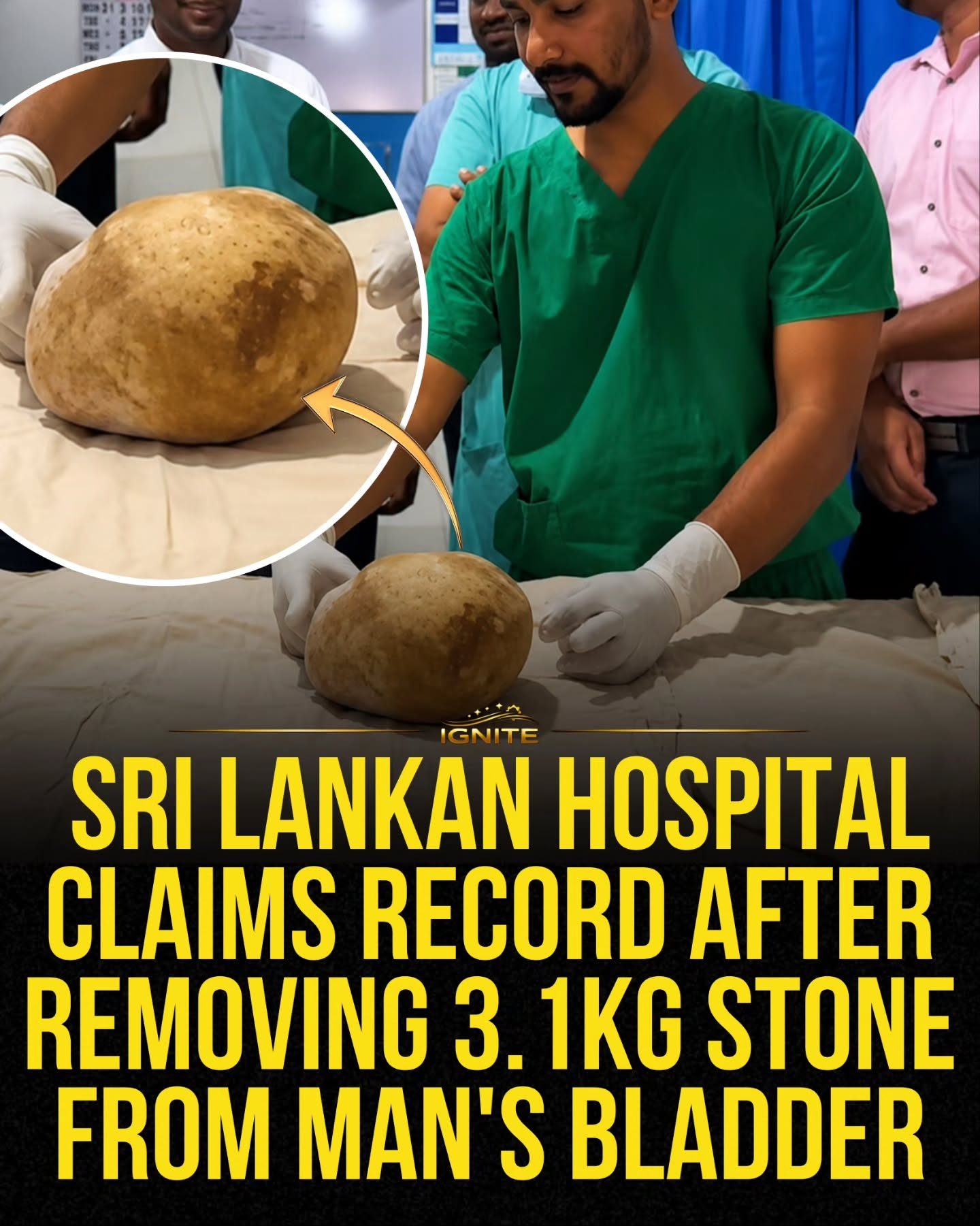 Sri Lankan Hospital Sets Record with 3.1kg Bladder Stone Removal
