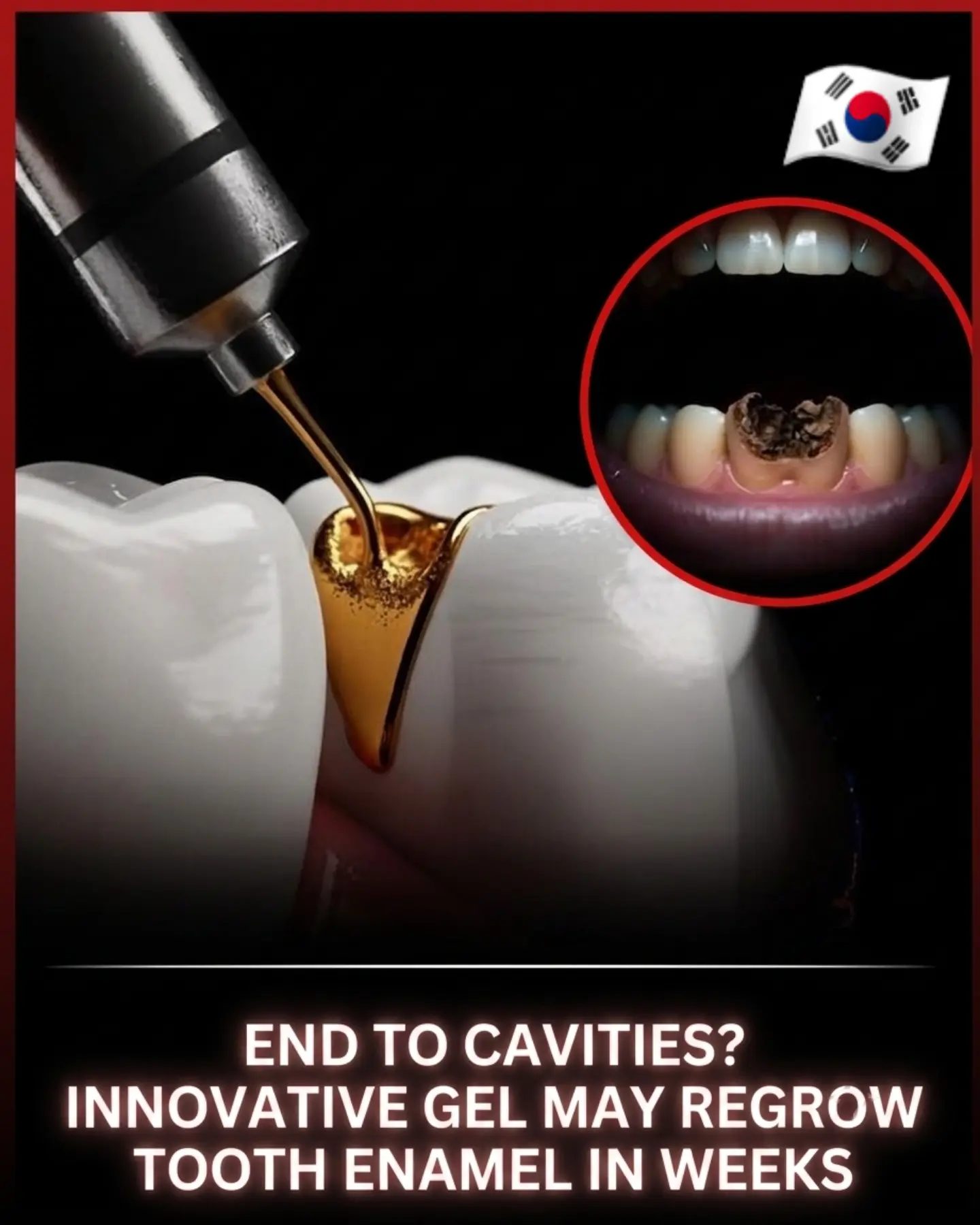 Innovative Dental Gel May Regrow Tooth Enamel