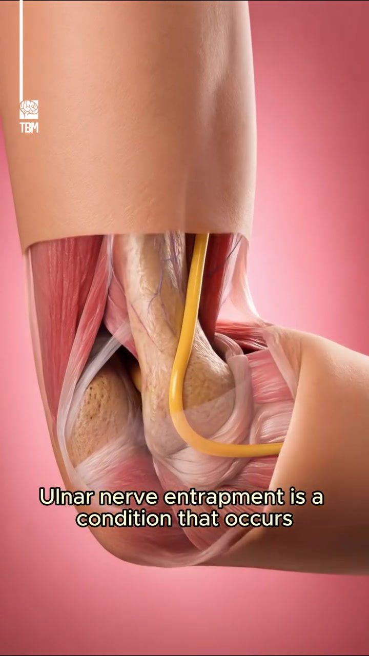 Understanding Ulnar Nerve Entrapment: Causes & Symptoms