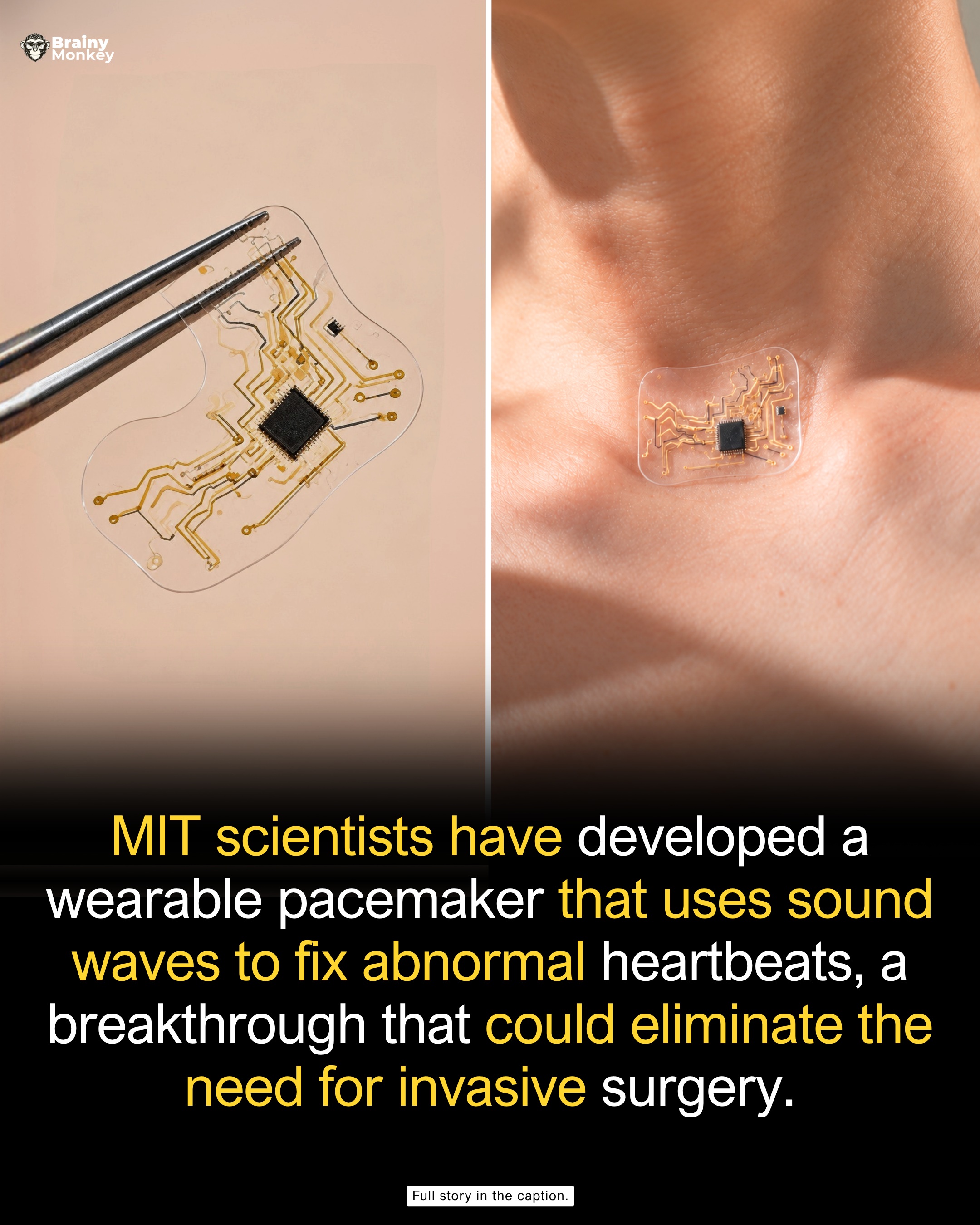 MIT Wearable Pacemaker: Non-Invasive Heartbeat Regulation
