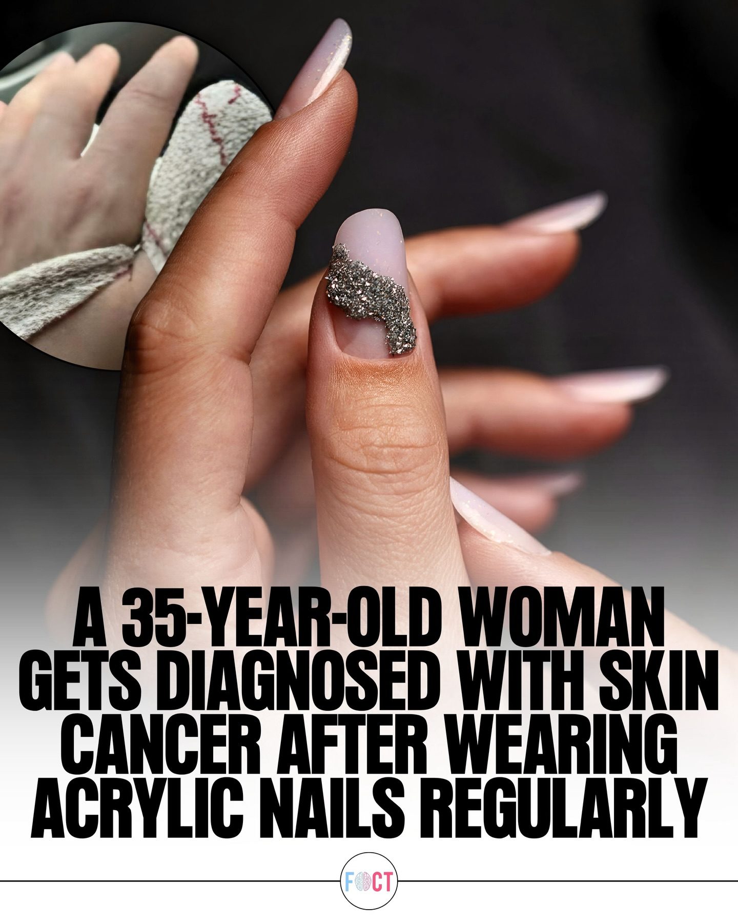 Acrylic Nails and Skin Cancer: What You Need to Know