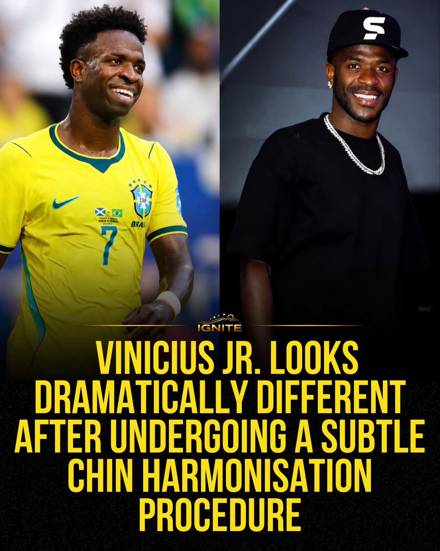 Vinicius Jr.'s Transformation: Chin Harmonization and IGNITE