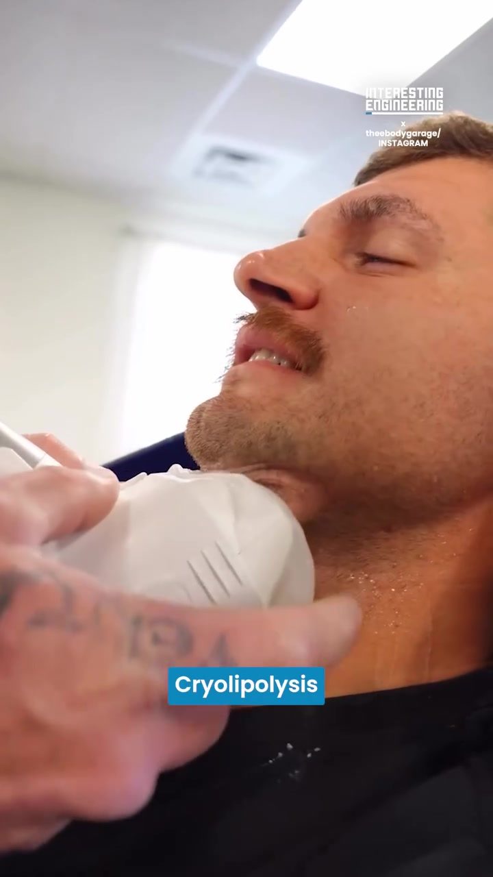 Cryolipolysis: A Non-Surgical Fat Reduction Solution
