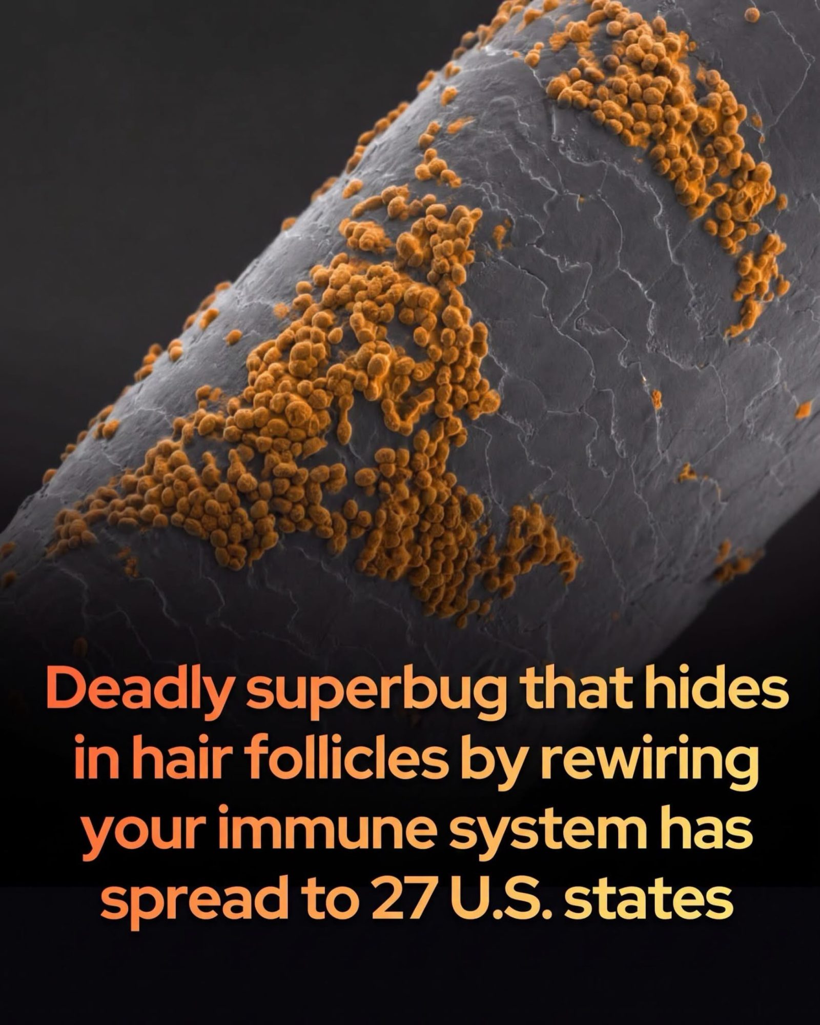 Superbug Candida Auris Spreads to 27 States