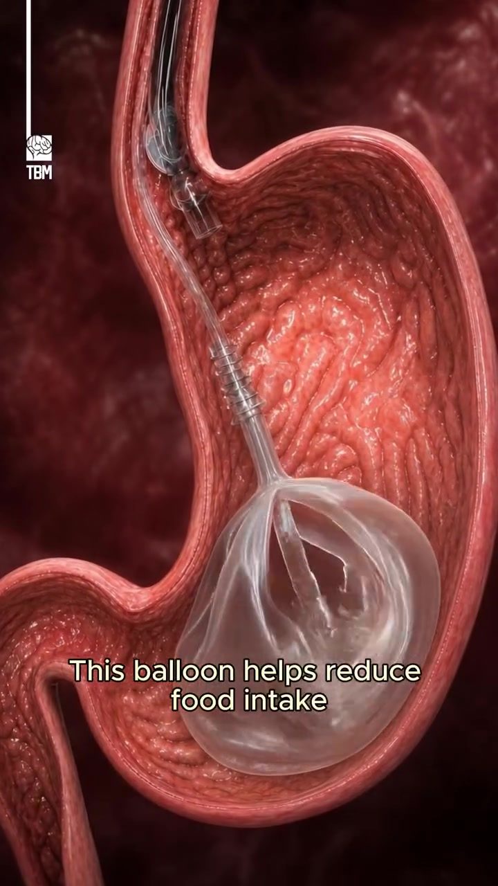 Non-Surgical Gastric Balloon: A Weight Loss Revolution