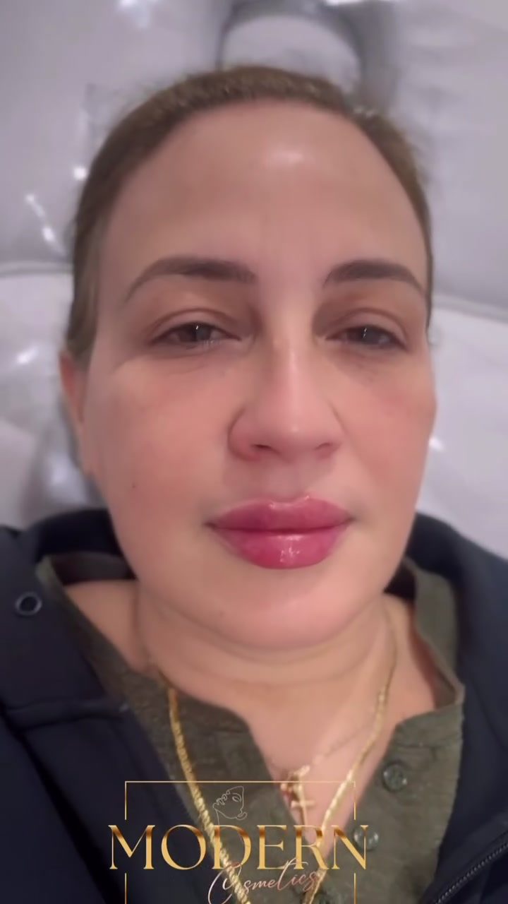 Modern Cosmetics: Lip Filler Consultations