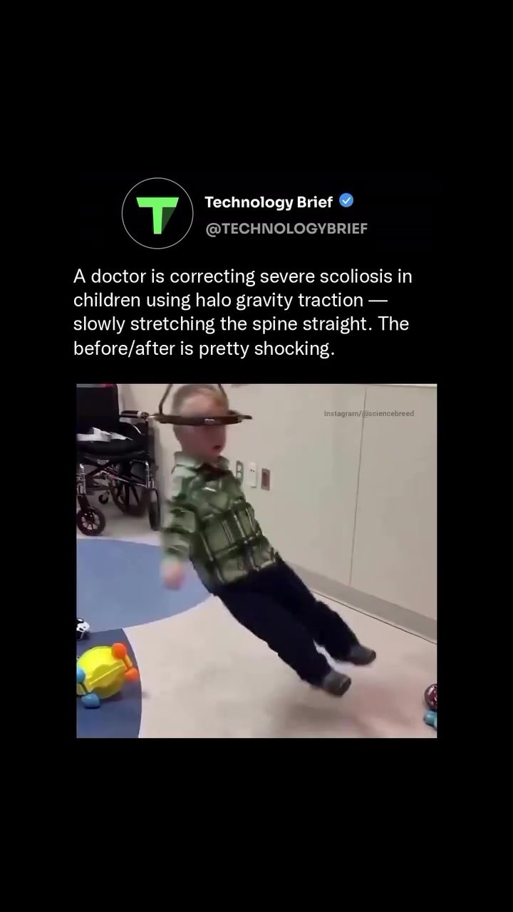 Halo Gravity Traction: Revolutionary Scoliosis Treatment for Children