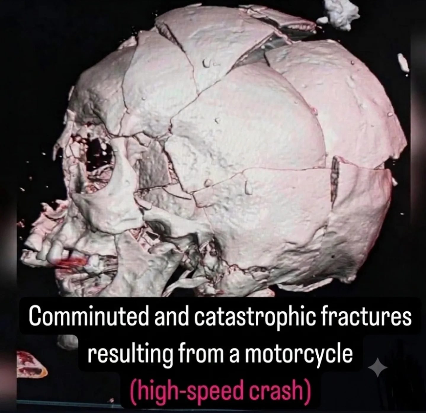 3D Medical Imaging: Severe Skull Fractures from Motorcycle Crashes