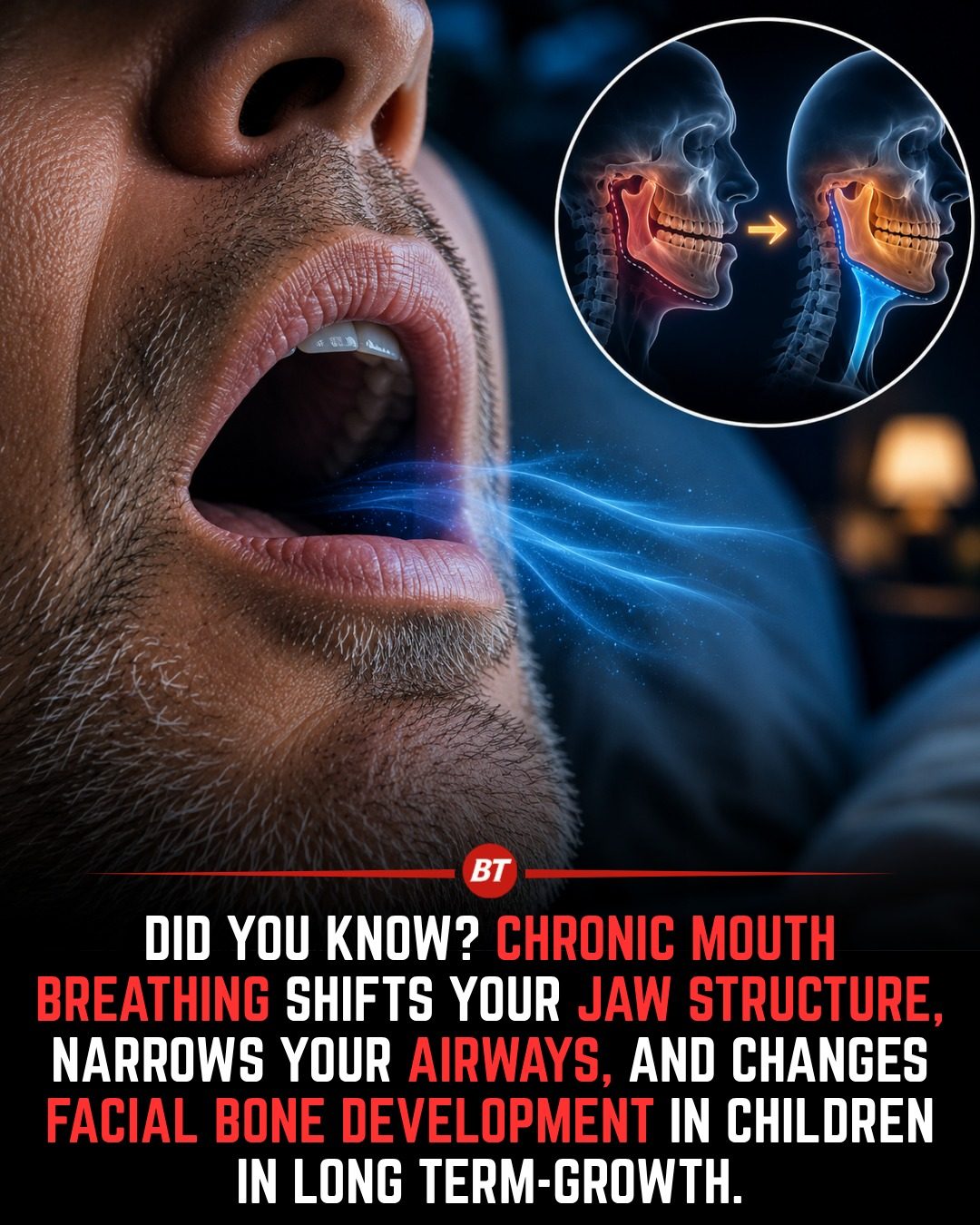 Chronic Mouth Breathing: How It Shapes a Child's Face and Jaw