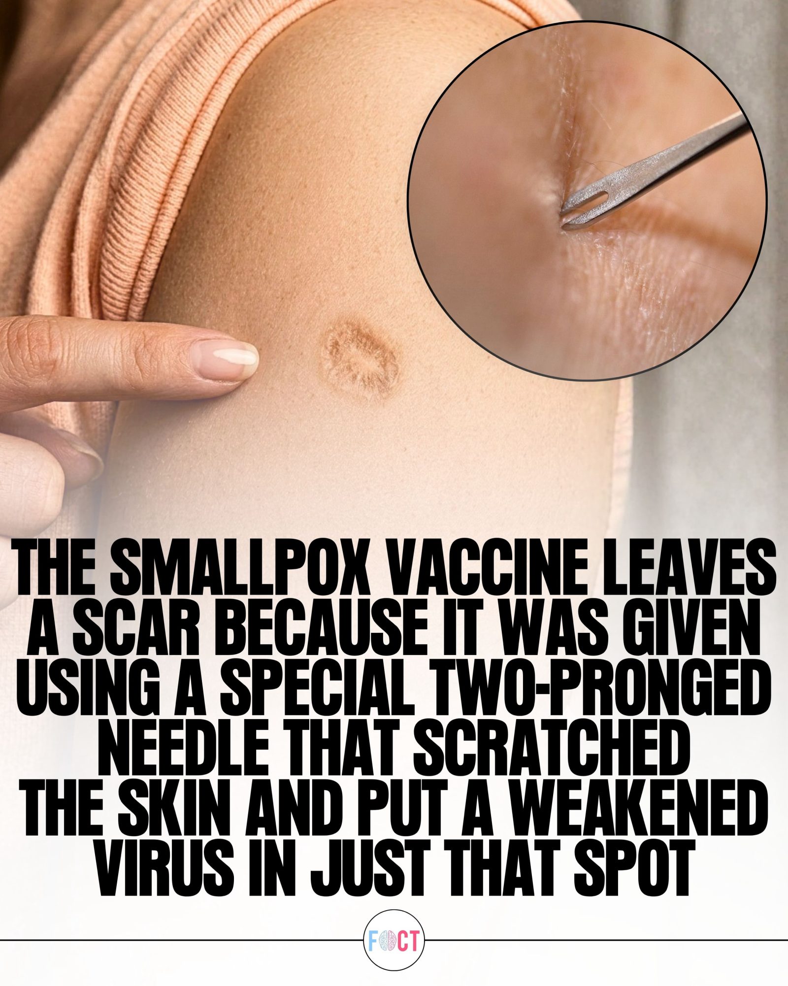 The Unique History of the Smallpox Vaccine Scar