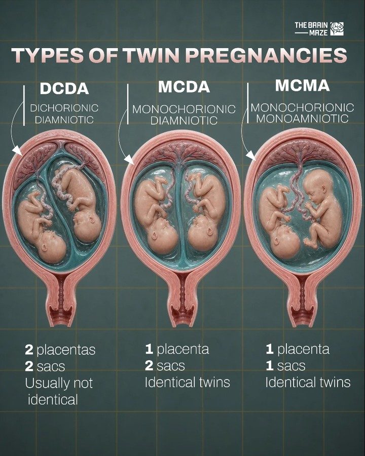 Understanding Twin Pregnancy Types: DCDA, MCDA, and MCMA