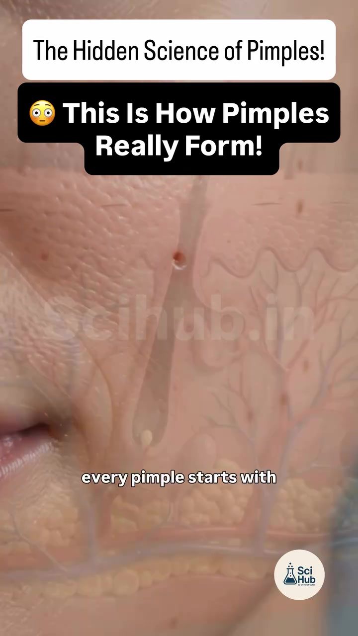 How Pimples Form: A Detailed Look at Skin Science
