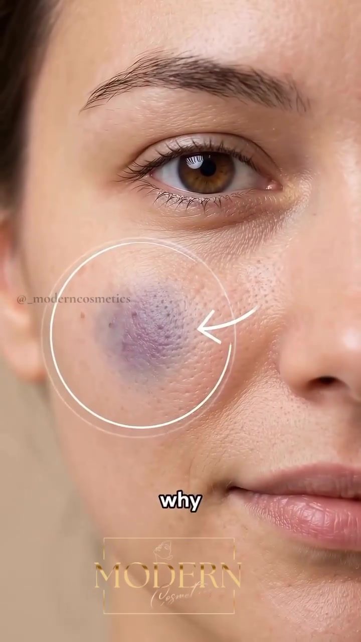 **Why Some People Bruise More Easily After Cosmetic Treatments**