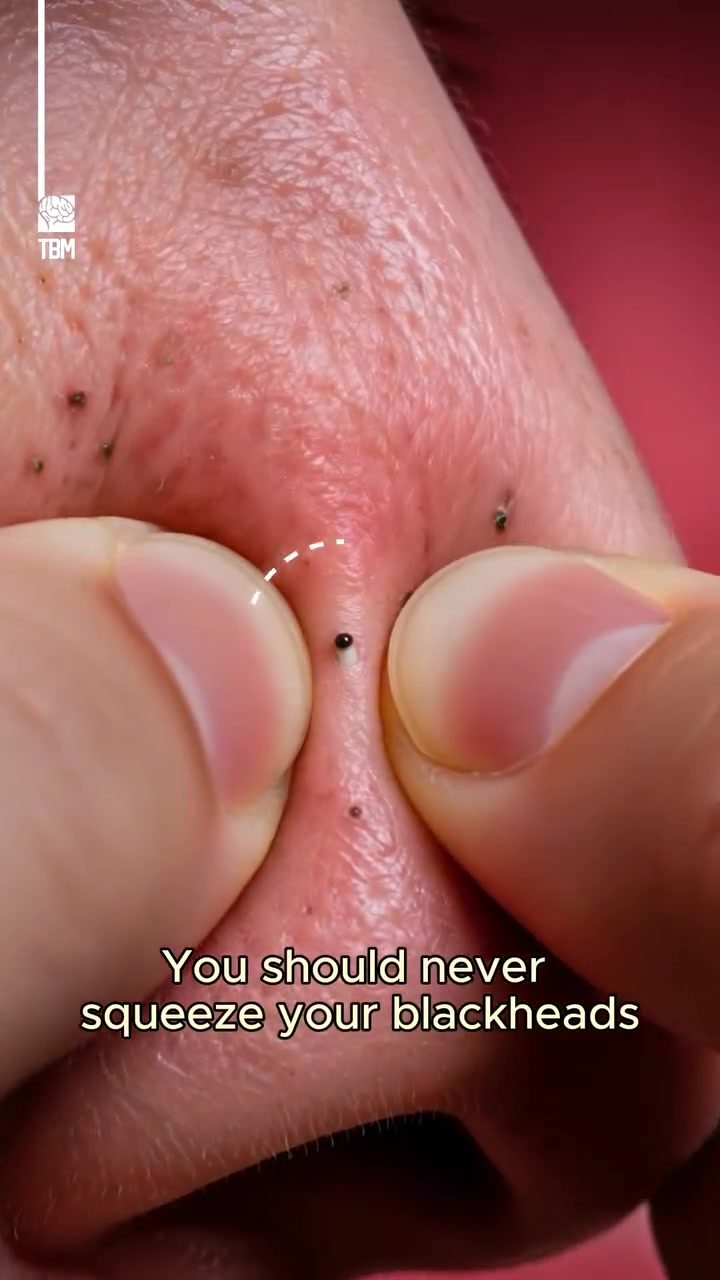 Why Squeezing Blackheads Causes Skin Damage