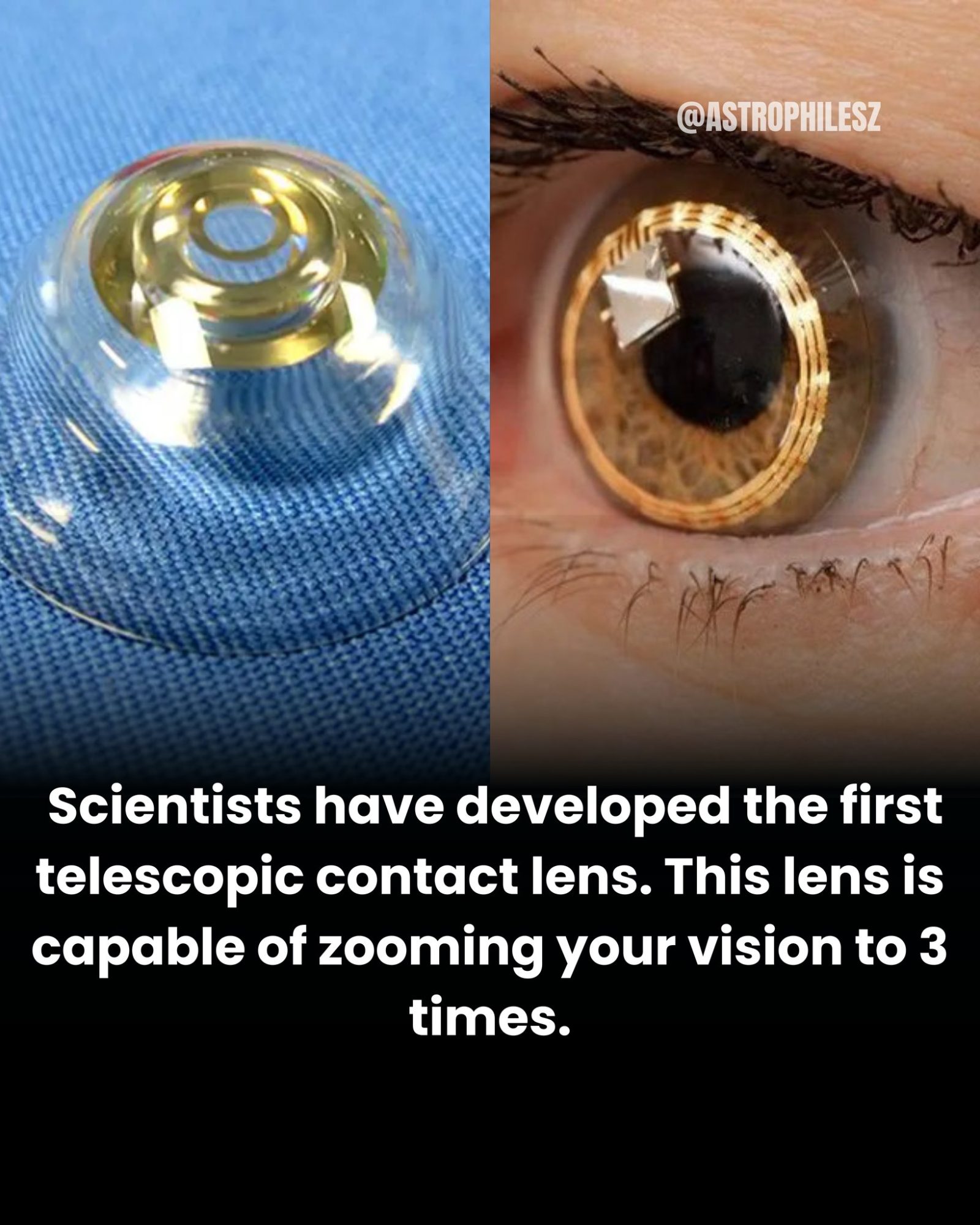 Telescopic Contact Lenses: Zoom with a Wink