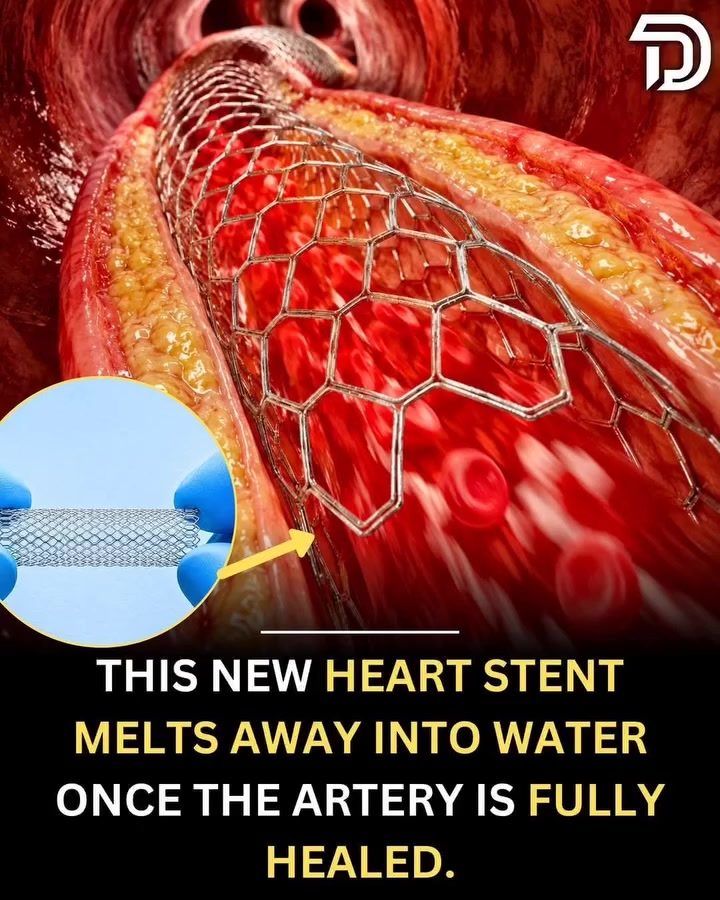 Dissolvable Heart Stents: A New Era in Heart Care
