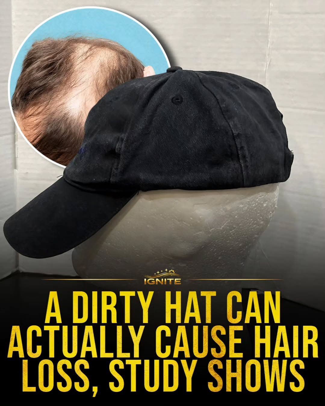 The Impact of Dirty Hats on Hair Loss: A Study by IGNITE
